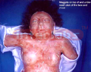Maggots on the body in a case of advanced putrefaction